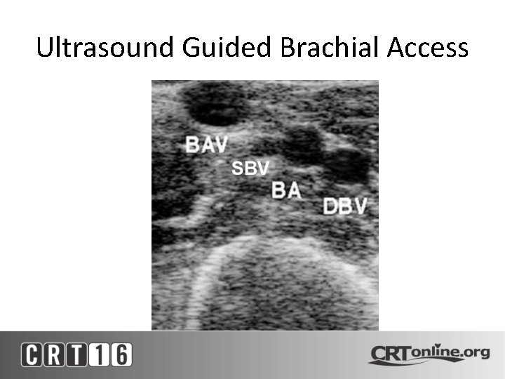 Ultrasound Guided Brachial Access 