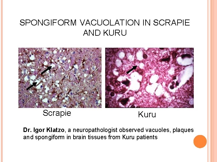 SPONGIFORM VACUOLATION IN SCRAPIE AND KURU Scrapie Kuru Dr. Igor Klatzo, a neuropathologist observed