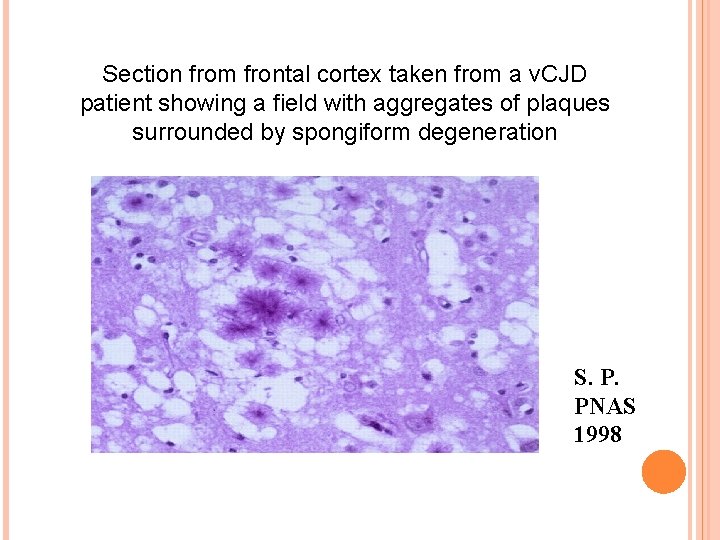 Section from frontal cortex taken from a v. CJD patient showing a field with