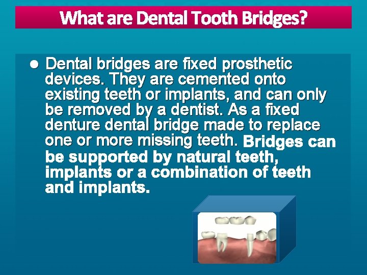 l Dental bridges are fixed prosthetic devices. They are cemented onto existing teeth or