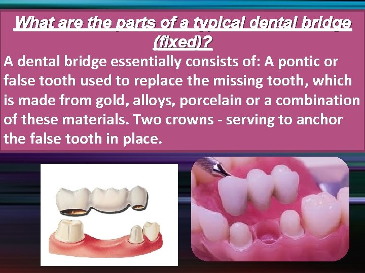 What are the parts of a typical dental bridge (fixed)? A dental bridge essentially