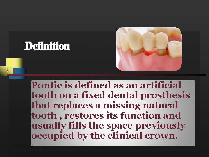 Definition Pontic is defined as an artificial tooth on a fixed dental prosthesis that