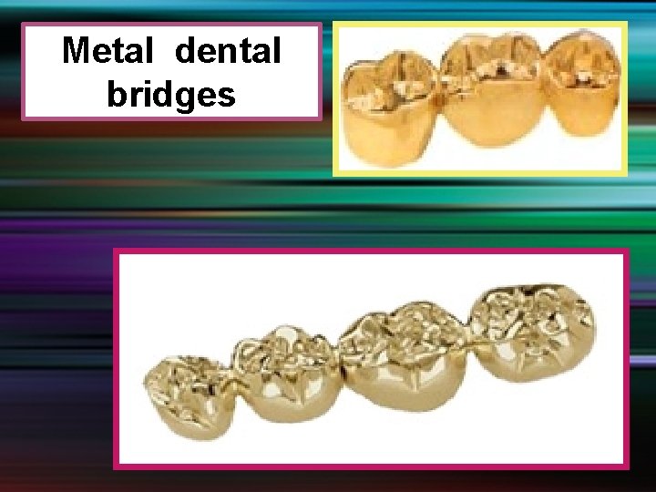 Metal dental bridges 
