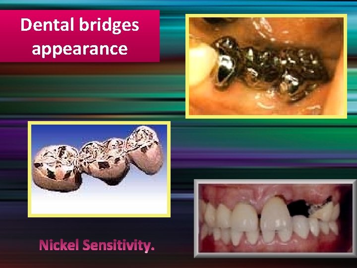 Dental bridges appearance 