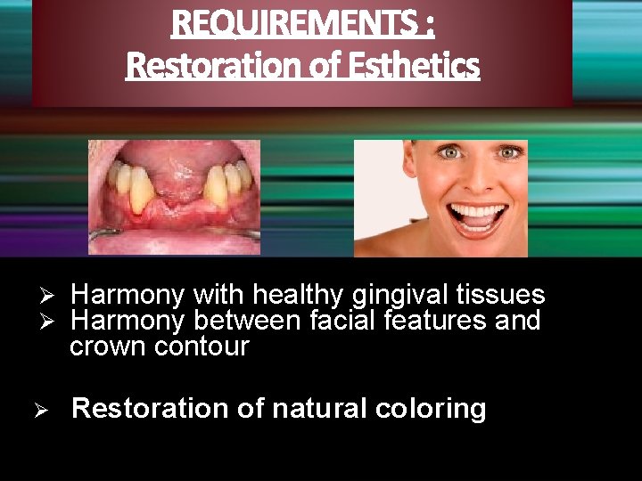 Ø Ø Harmony with healthy gingival tissues Harmony between facial features and crown contour