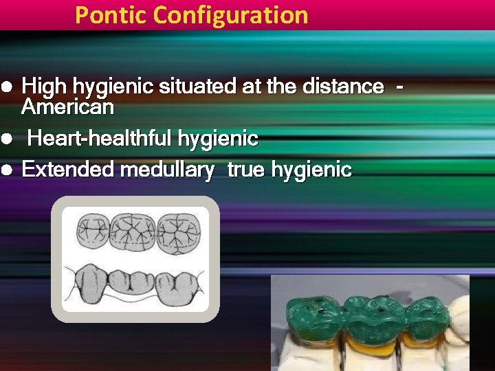 Pontic Configuration High hygienic situated at the distance American l Heart-healthful hygienic l Extended