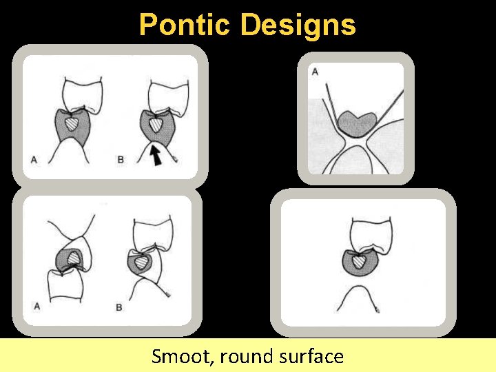 Pontic Designs Smoot, round surface 