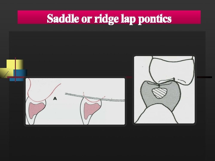 Saddle or ridge lap pontics 