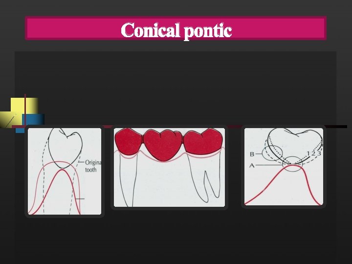 Conical pontic 