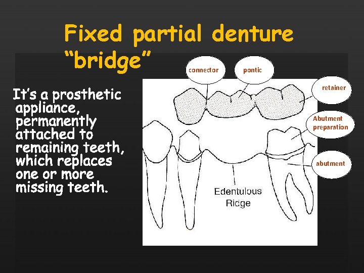 Fixed partial denture “bridge” connector pontic retainer Abutment preparation abutment 