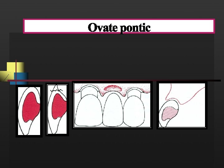 Ovate pontic 