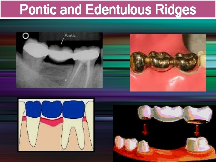 Pontic and Edentulous Ridges 