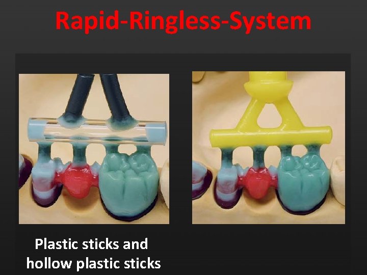 Rapid-Ringless-System Plasticks and hollow plasticks 