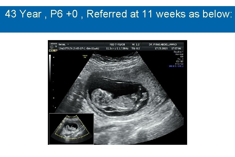 43 Year , P 6 +0 , Referred at 11 weeks as below: 