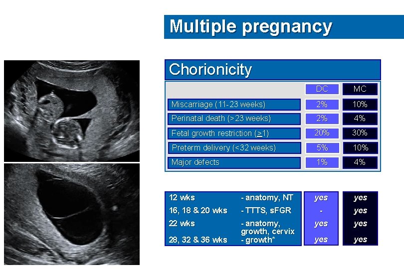 Multiple pregnancy Chorionicity DC MC Miscarriage (11 -23 weeks) 2% 10% Perinatal death (>23