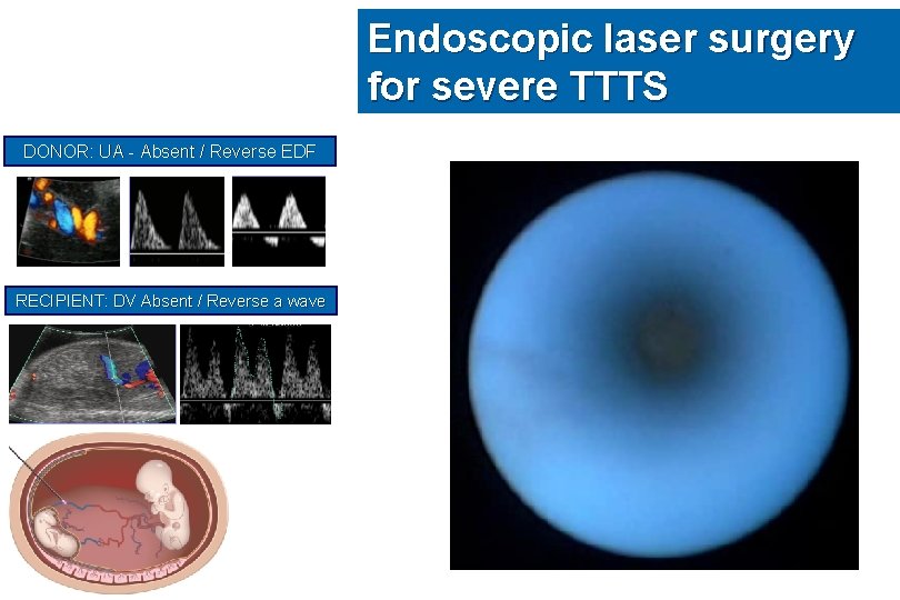 Endoscopic laser surgery for severe TTTS DONOR: UA - Absent / Reverse EDF RECIPIENT:
