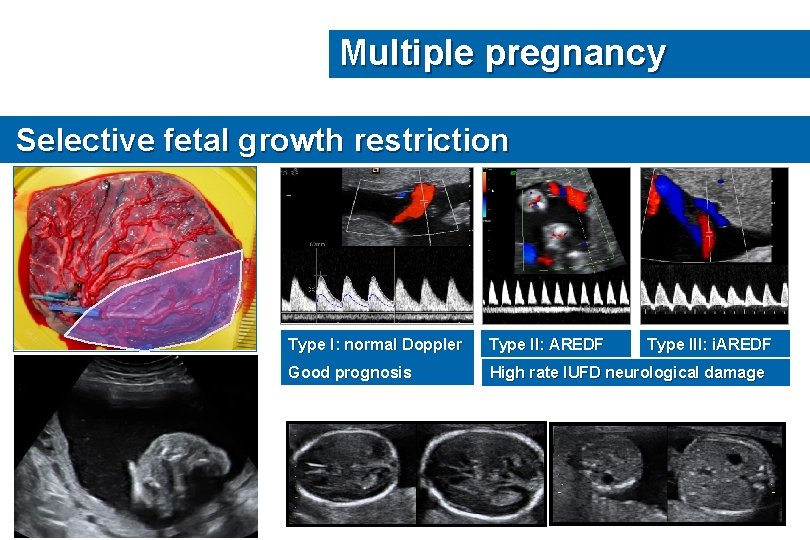 Multiple pregnancy Selective fetal growth restriction Type I: normal Doppler Type II: AREDF Type