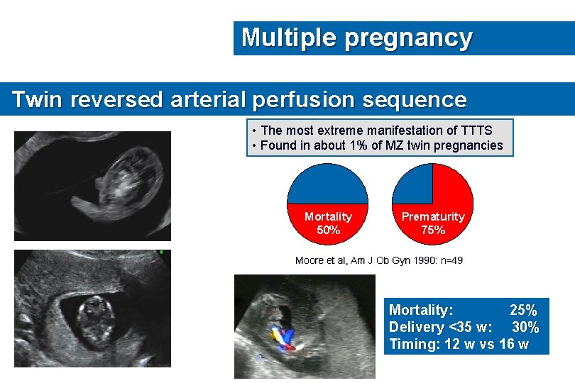 Multiple pregnancy Twin reversed arterial perfusion sequence • The most extreme manifestation of TTTS