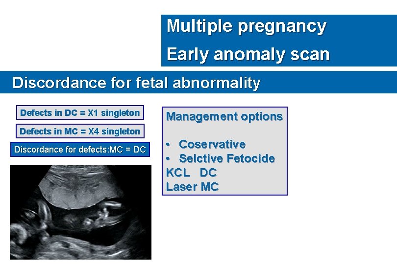 Multiple pregnancy Early anomaly scan Discordance for fetal abnormality Defects in DC = X