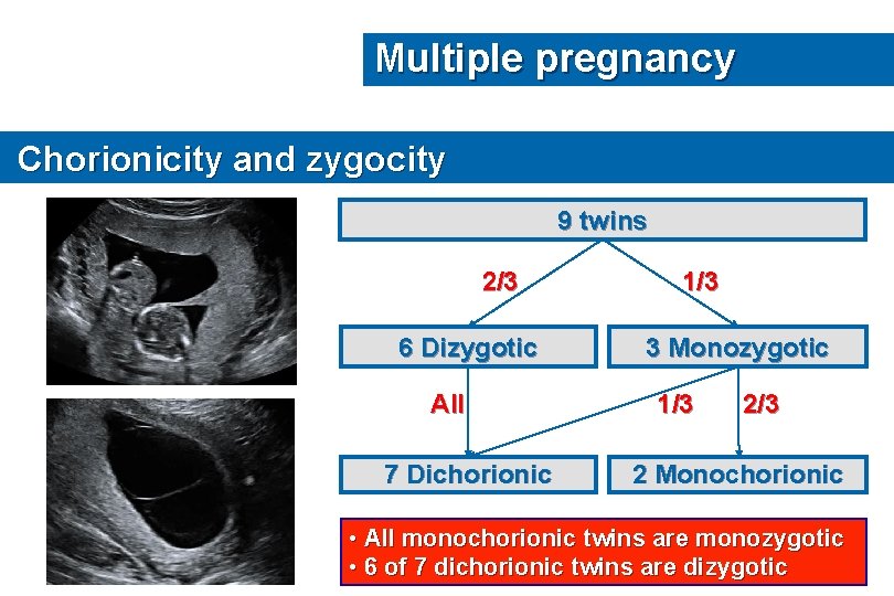 Multiple pregnancy Chorionicity and zygocity 9 twins 2/3 6 Dizygotic All 7 Dichorionic 1/3