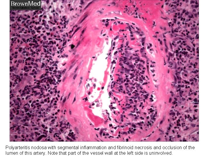 Polyarteritis nodosa with segmental inflammation and fibrinoid necrosis and occlusion of the lumen of