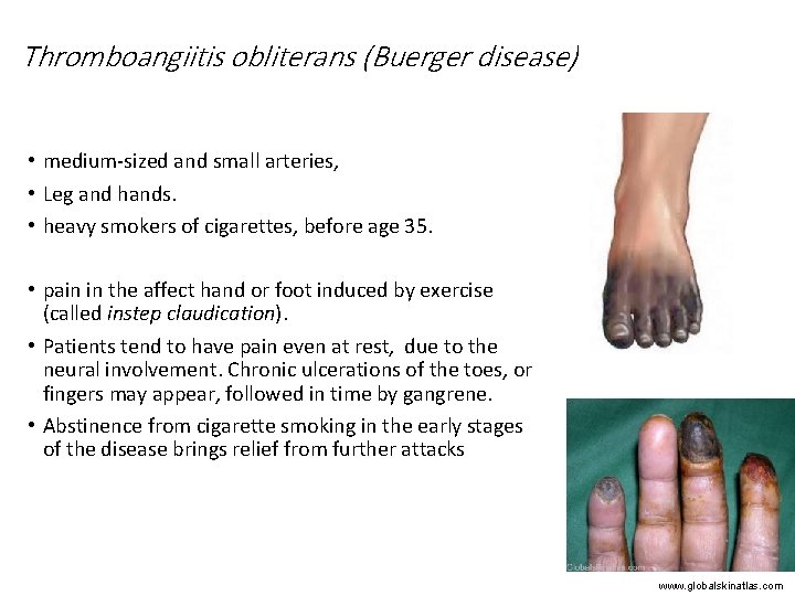 Thromboangiitis obliterans (Buerger disease) • medium-sized and small arteries, • Leg and hands. •