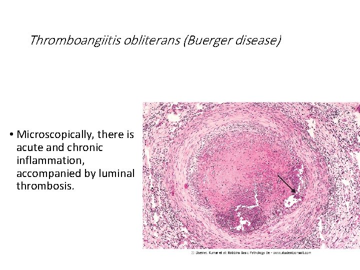 Thromboangiitis obliterans (Buerger disease) • Microscopically, there is acute and chronic inflammation, accompanied by