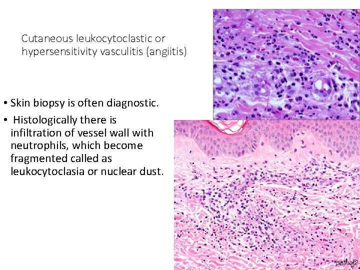 Cutaneous leukocytoclastic or hypersensitivity vasculitis (angiitis) • Skin biopsy is often diagnostic. • Histologically