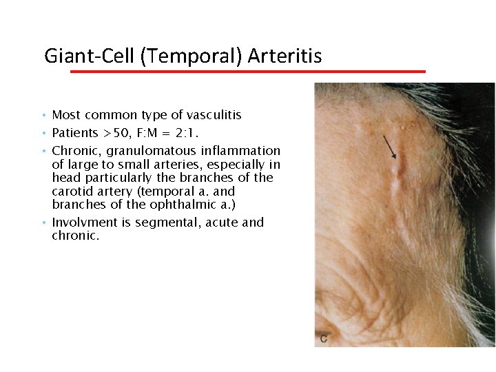  Giant-Cell (Temporal) Arteritis • Most common type of vasculitis • Patients >50, F: