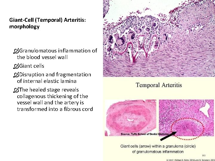Giant-Cell (Temporal) Arteritis: morphology Granulomatous inflammation of the blood vessel wall Giant cells Disruption