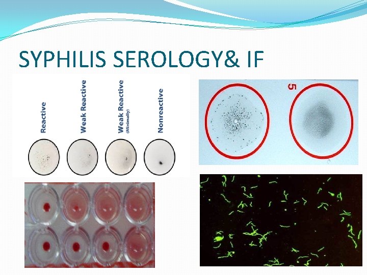 SYPHILIS SEROLOGY& IF SYPHILIS SEROLOGY& IF