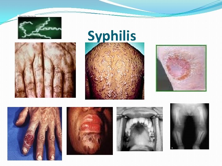 Syphilis Syphilis