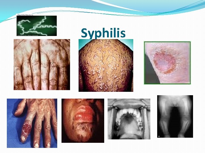 Syphilis 