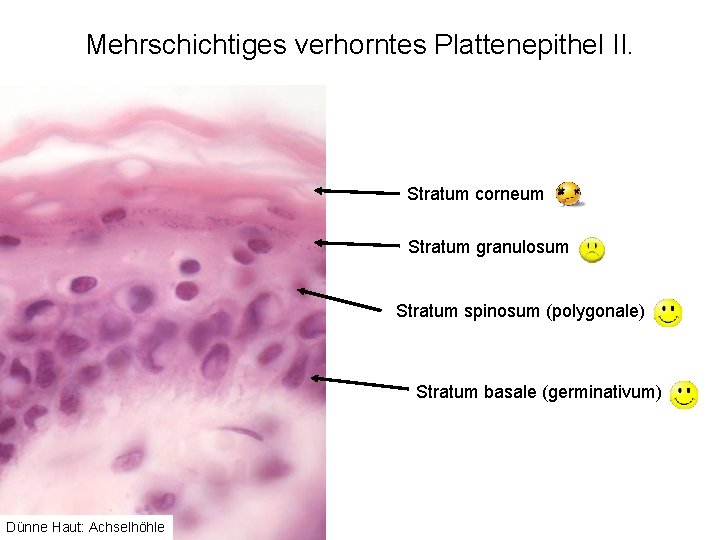 Mehrschichtiges verhorntes Plattenepithel II. Stratum corneum Stratum granulosum Stratum spinosum (polygonale) Stratum basale (germinativum)