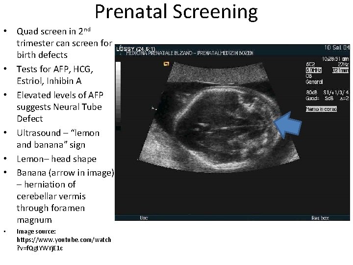 Prenatal Screening • Quad screen in 2 nd trimester can screen for birth defects