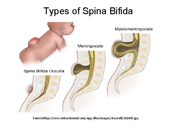 Types of Spina Bifida Source: http: //www. nebraskamed. com/app_files/images/staywell/161405. jpg 