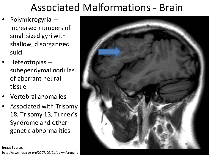 Associated Malformations - Brain • Polymicrogyria – increased numbers of small sized gyri with
