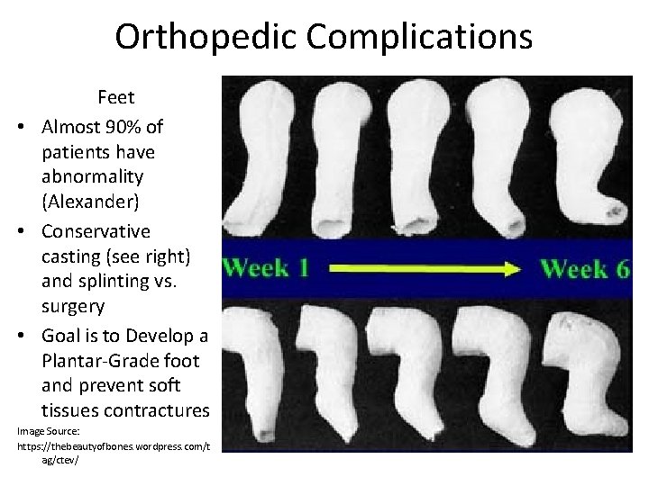 Orthopedic Complications Feet • Almost 90% of patients have abnormality (Alexander) • Conservative casting