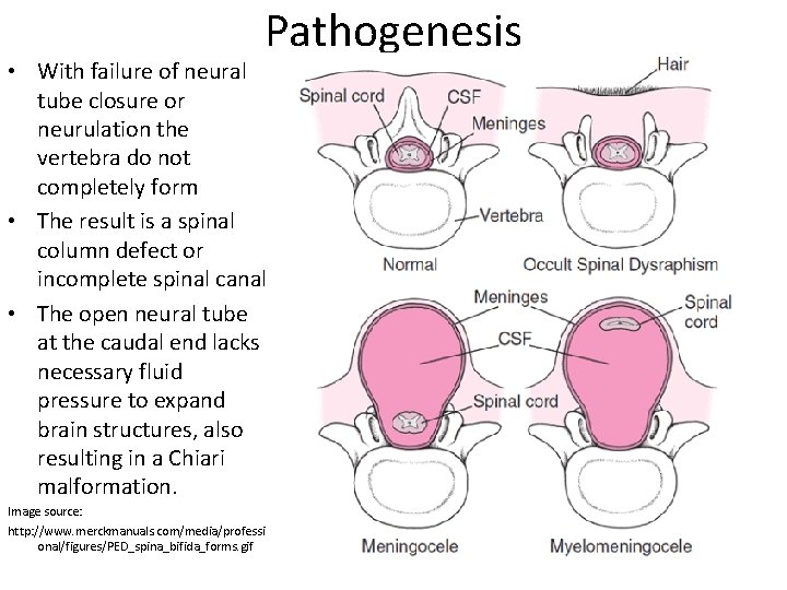 Pathogenesis • With failure of neural tube closure or neurulation the vertebra do not
