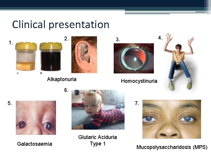 Clinical presentation 2. 1. 4. 3. Alkaptonuria Homocystinuria 6. 5. 7. Galactosaemia Glutaric Aciduria