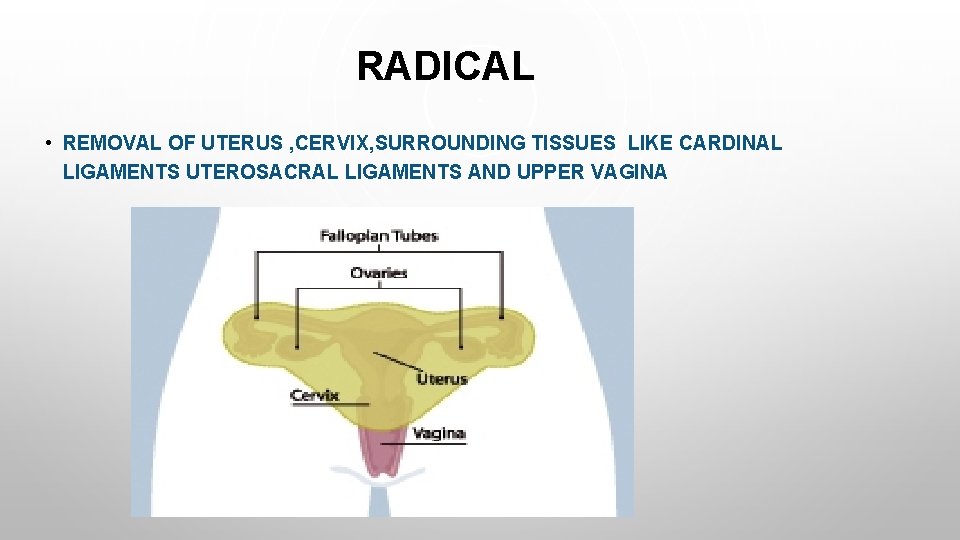RADICAL • REMOVAL OF UTERUS , CERVIX, SURROUNDING TISSUES LIKE CARDINAL LIGAMENTS UTEROSACRAL LIGAMENTS