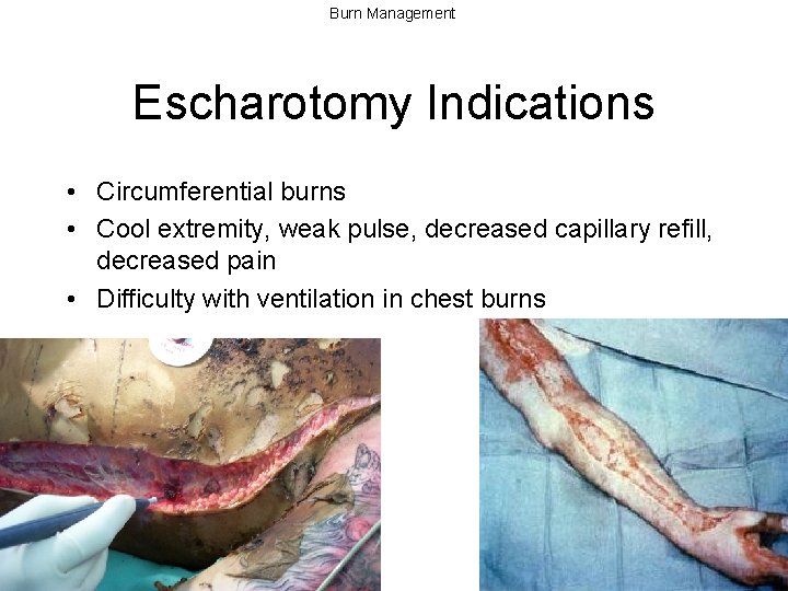Burn Management Escharotomy Indications • Circumferential burns • Cool extremity, weak pulse, decreased capillary