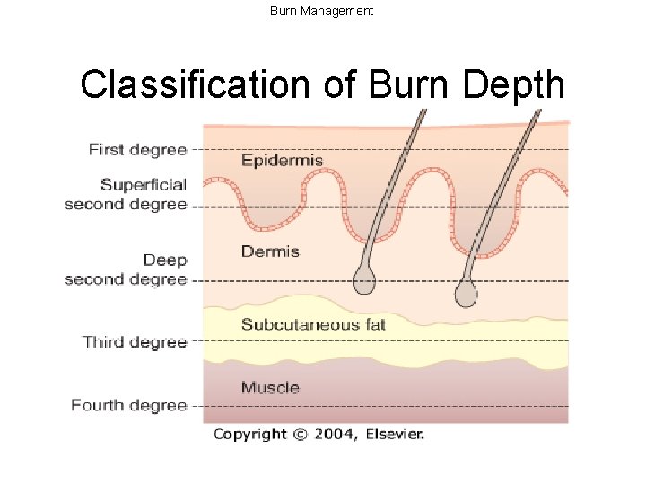 Burn Management Classification of Burn Depth 