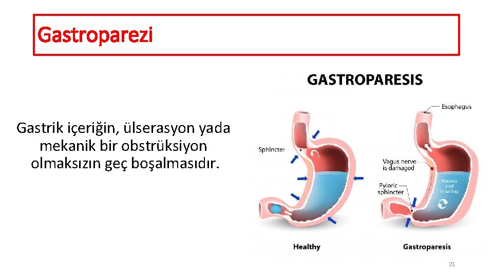 Gastroparezi Gastrik içeriğin, ülserasyon yada mekanik bir obstrüksiyon olmaksızın geç boşalmasıdır. 21 