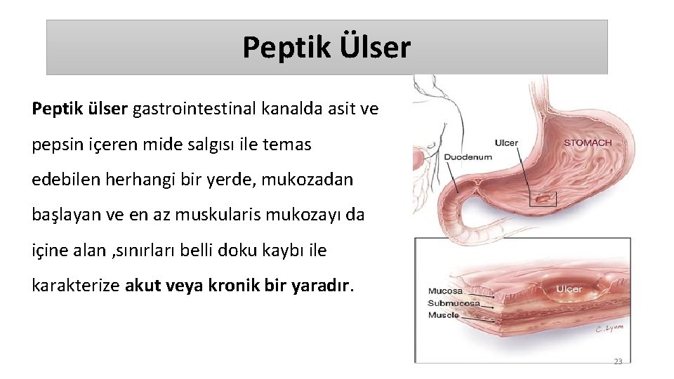 Peptik Ülser Peptik ülser gastrointestinal kanalda asit ve pepsin içeren mide salgısı ile temas