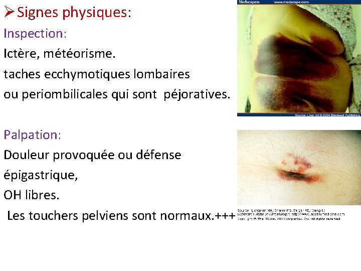 Ø Signes physiques: Inspection: Ictère, météorisme. taches ecchymotiques lombaires ou periombilicales qui sont péjoratives.