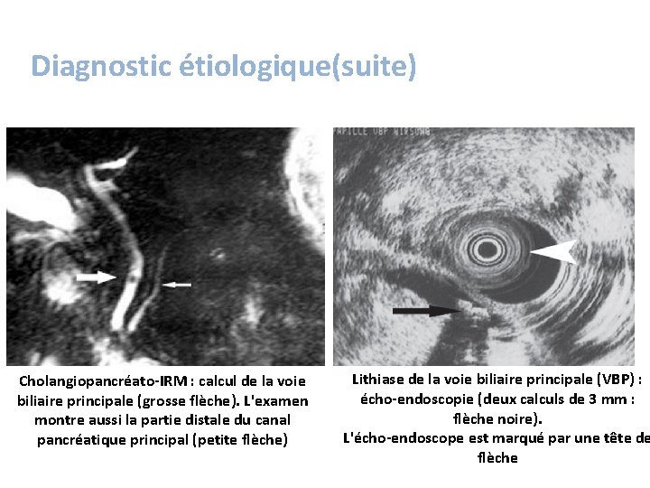 Diagnostic étiologique(suite) Cholangiopancréato-IRM : calcul de la voie biliaire principale (grosse flèche). L'examen montre