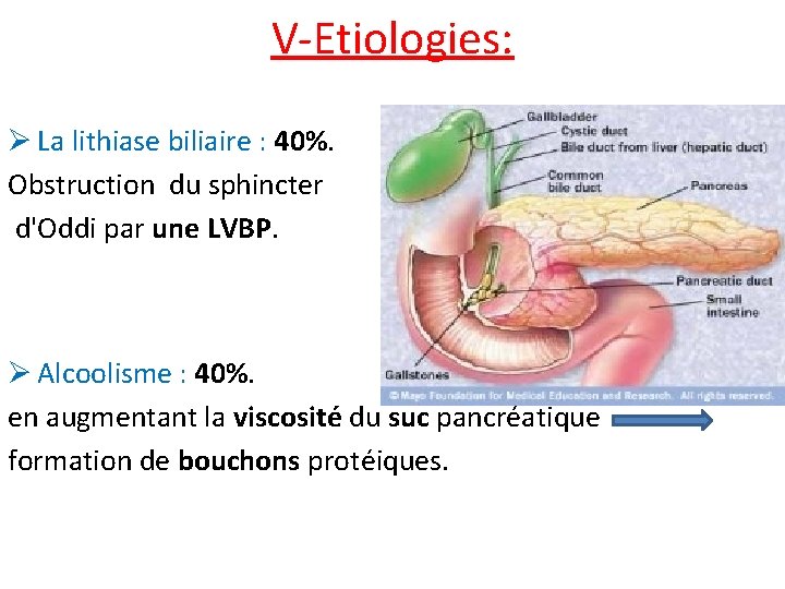 V-Etiologies: Ø La lithiase biliaire : 40%. Obstruction du sphincter d'Oddi par une LVBP.