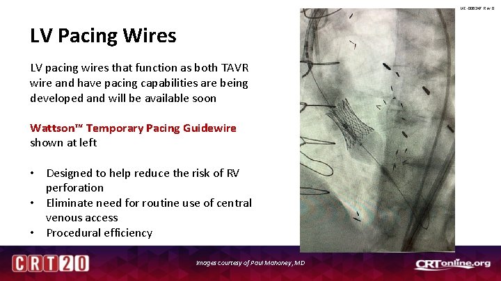 MC-006247 Rev 0 LV Pacing Wires LV pacing wires that function as both TAVR