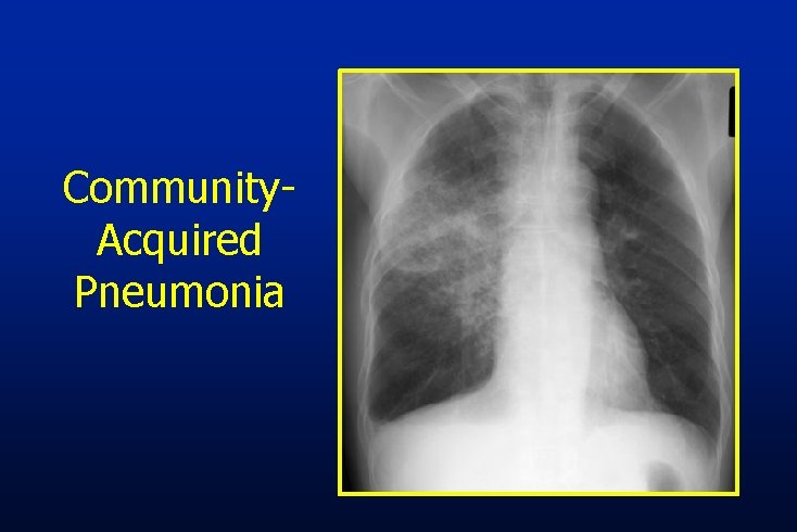 Community. Acquired Pneumonia 